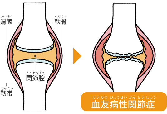 関節内出血を繰り返すと…